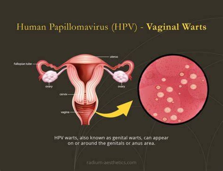 Are HPV warts permanent?