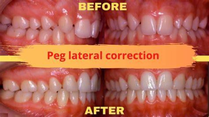 Are peg laterals hereditary?