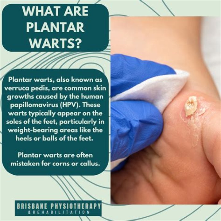 Are plantar warts an STD?