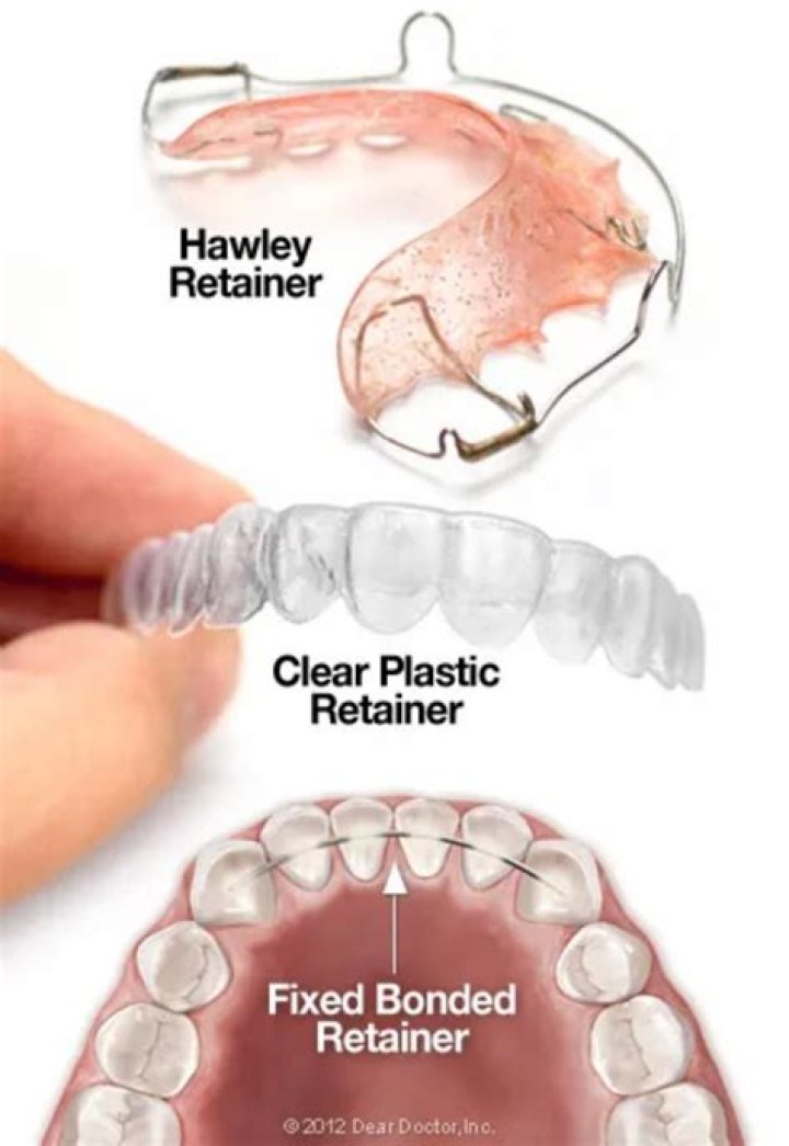 Are plastic or wire retainers better?