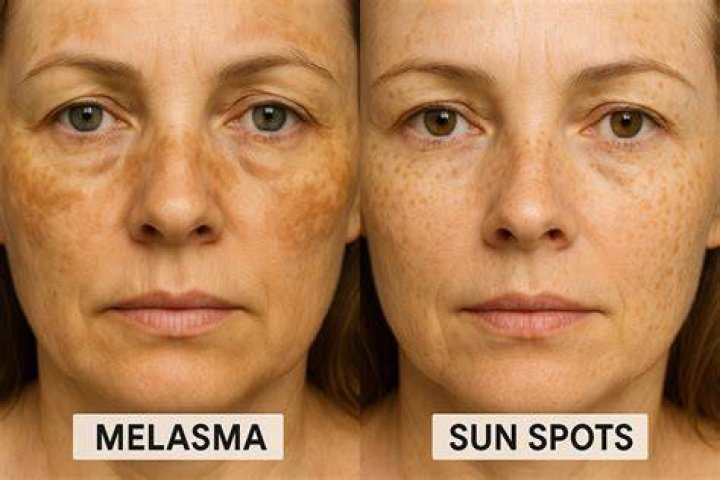 Are sun spots melasma?