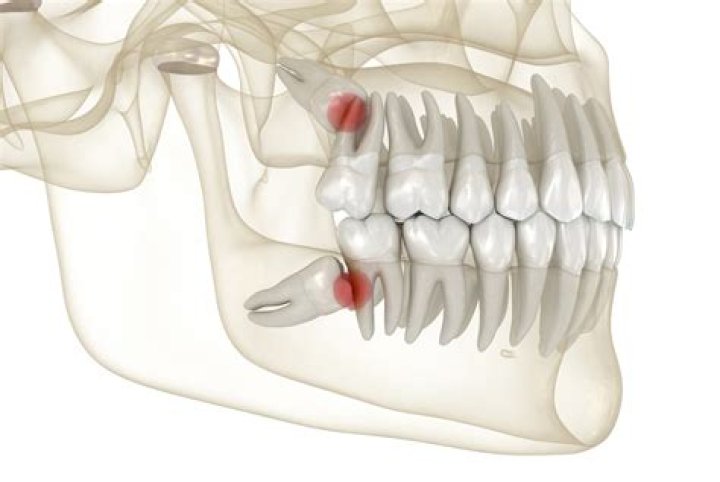 Are wisdom teeth hereditary?