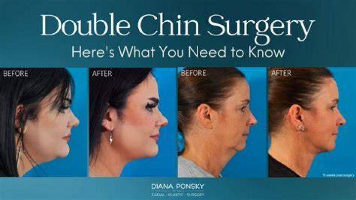 At what age do you get a double chin?