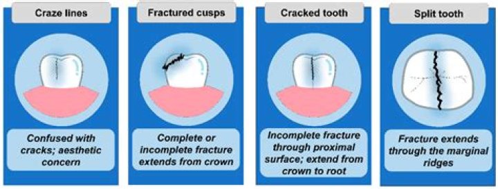 Can a dentist pull a broken tooth?
