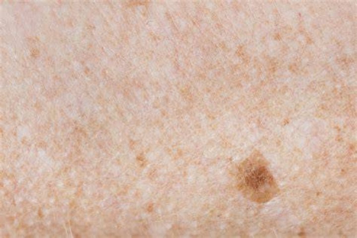 Can a freckle be melanoma?