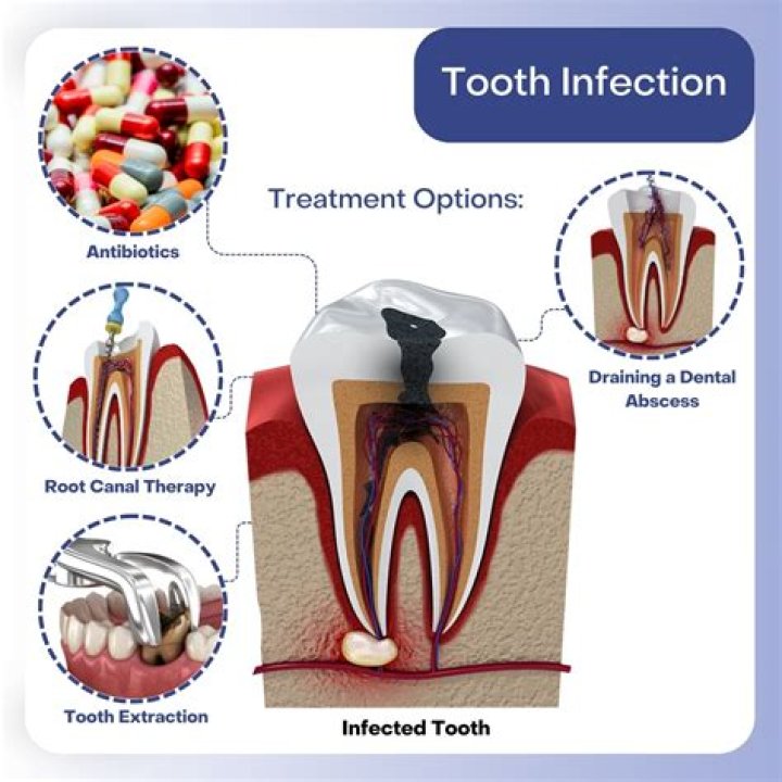 Can a pharmacist prescribe antibiotics for tooth abscess?