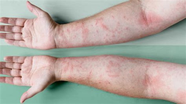 Can a pillow cause eczema?
