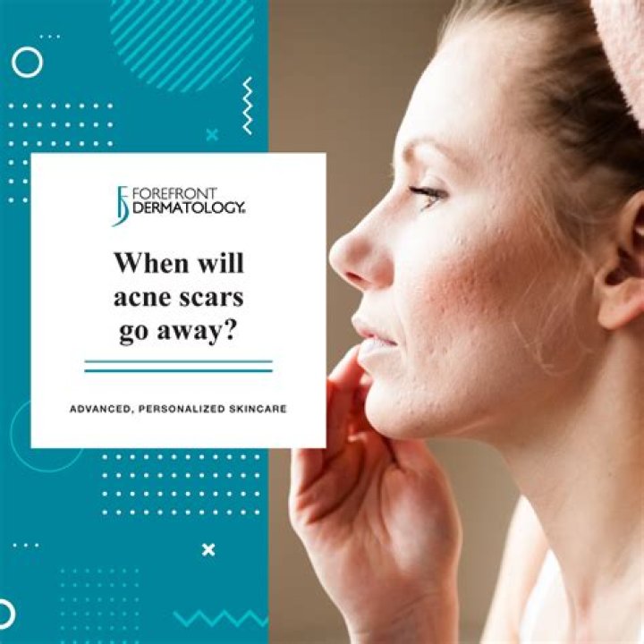 Can acne scars go away completely?