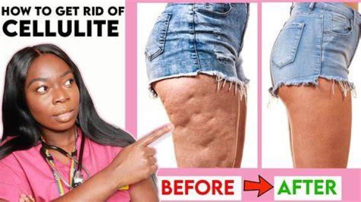 Can anything reduce cellulite?