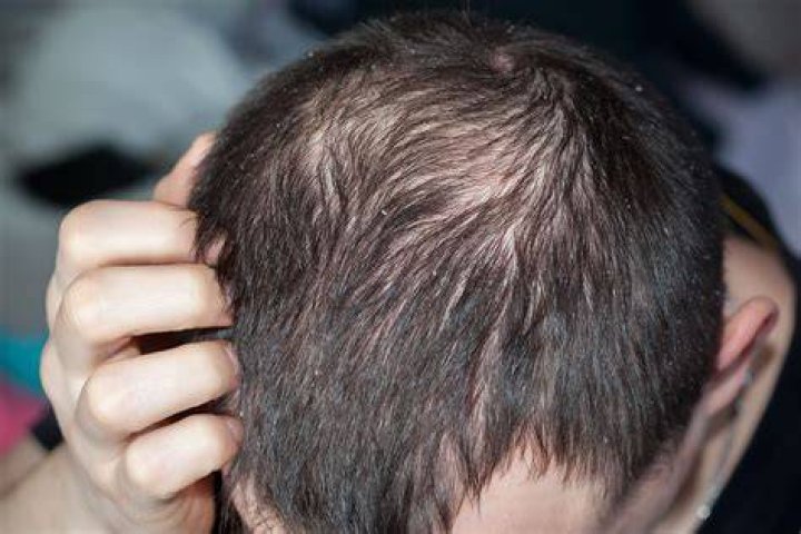 Can dandruff cause hair fall?