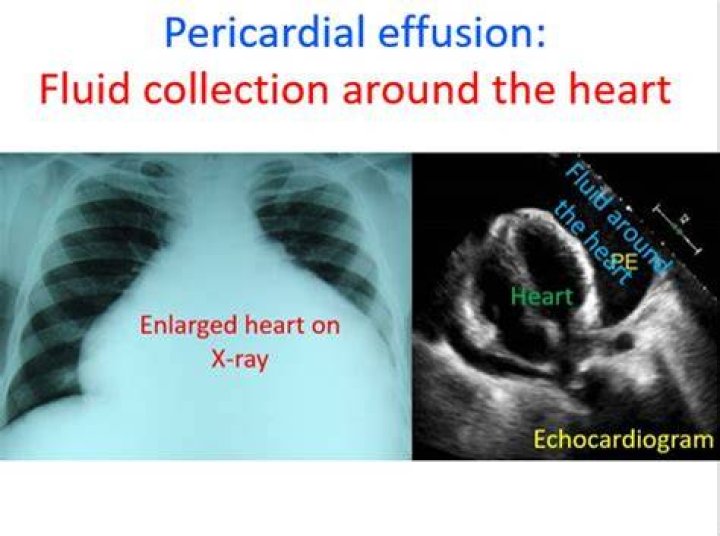 Can fluid around the heart go away on its own?
