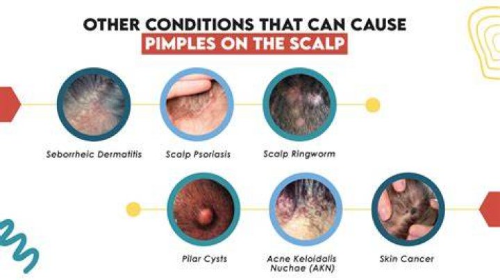 Can ginger cause pimples?
