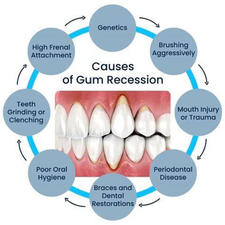 Can hydrogen peroxide reverse receding gums?