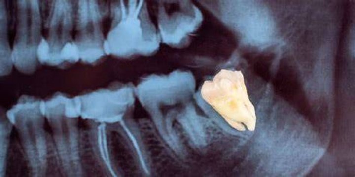 Can I go to work the next day after wisdom tooth extraction?