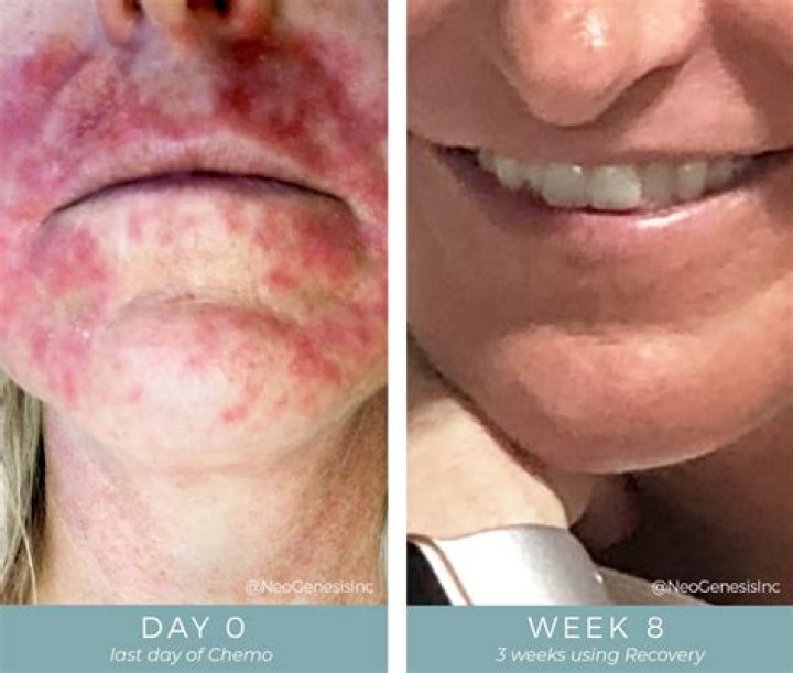 Can I stop using Faiza cream?