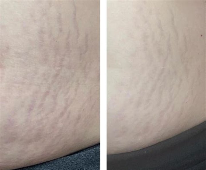 Can I use retinol on my thighs?
