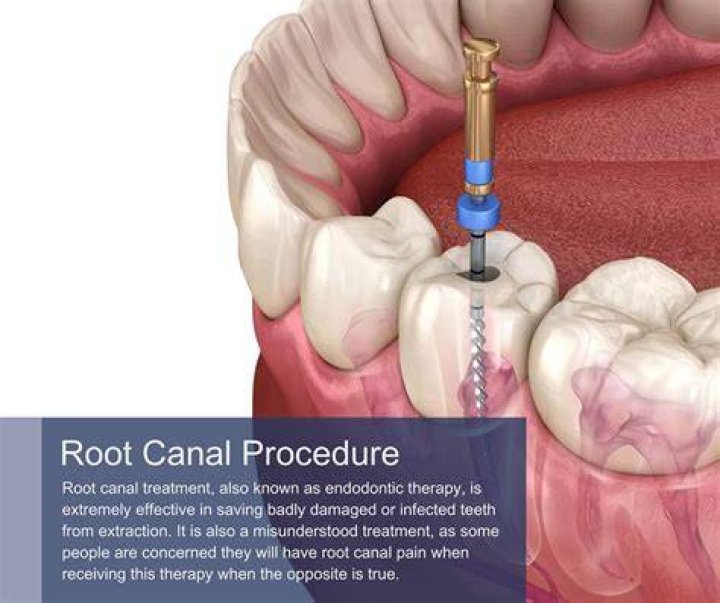 Can I write off a root canal?