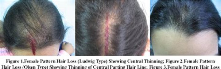 Can low iron cause hair loss?