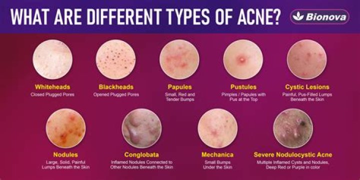 Can normal skin have acne?