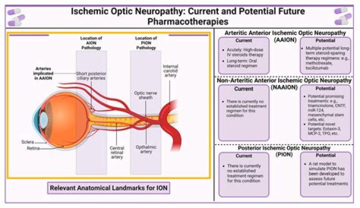 Can optic neuritis cause fatigue?