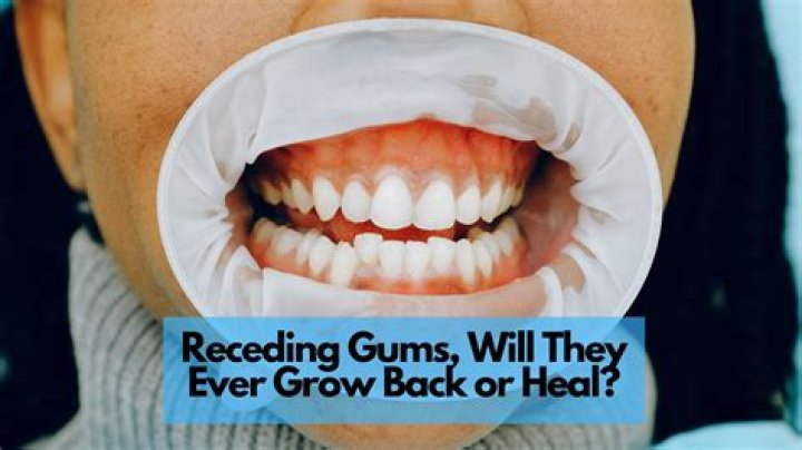 Can receding gums come back?