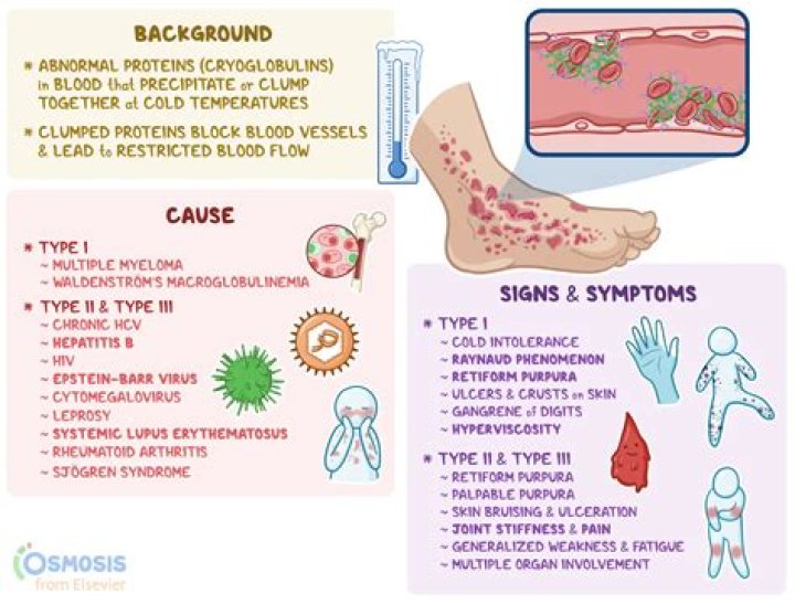 Can sjogrens lead to lymphoma?