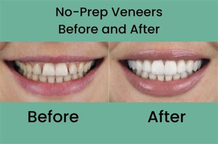 Can veneers be removed and not replaced?