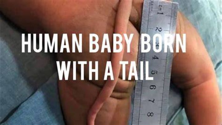 Can you be born with a tail?