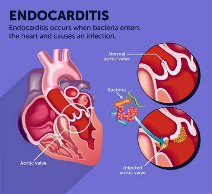Can you get endocarditis from flossing?