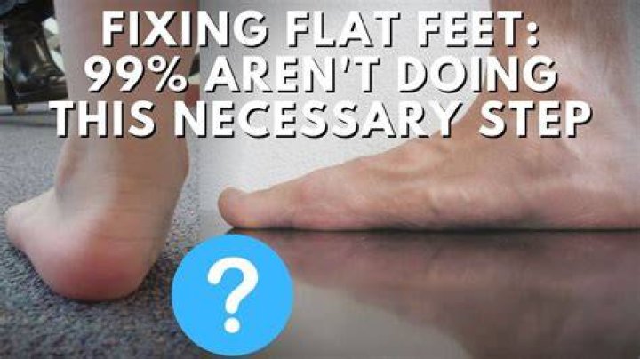 Can you permanently fix flat feet?