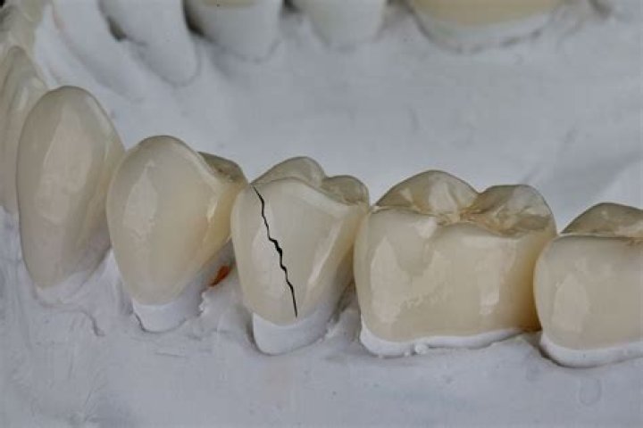 Can you replace a crown with bonding?