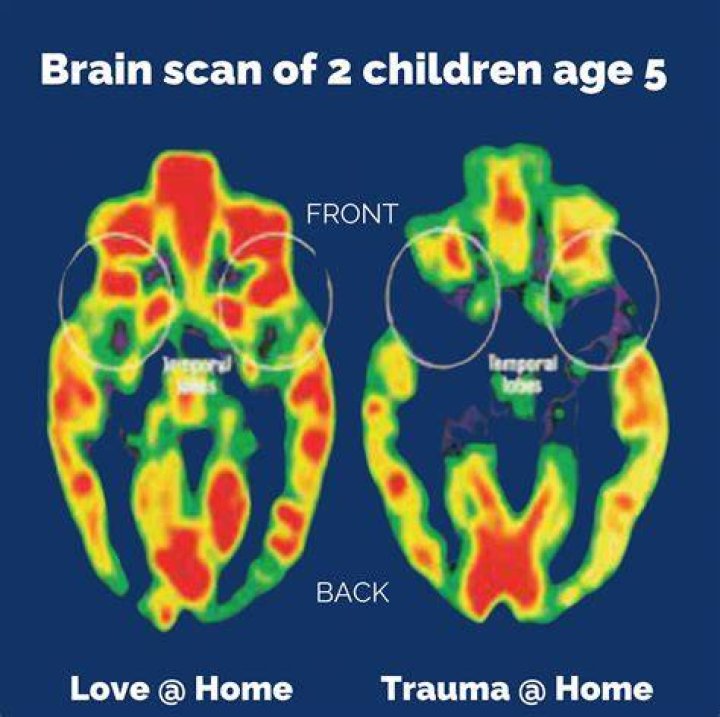 Can you see bipolar on a brain scan?