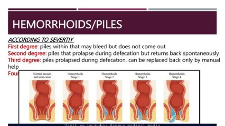Can you squeeze a hemorrhoid?