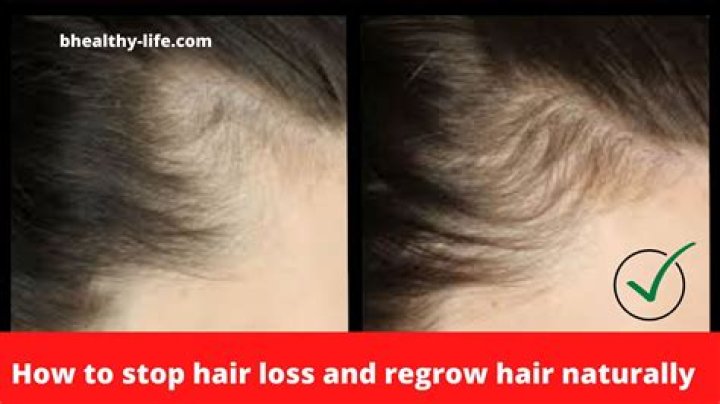Can you stop hair loss?