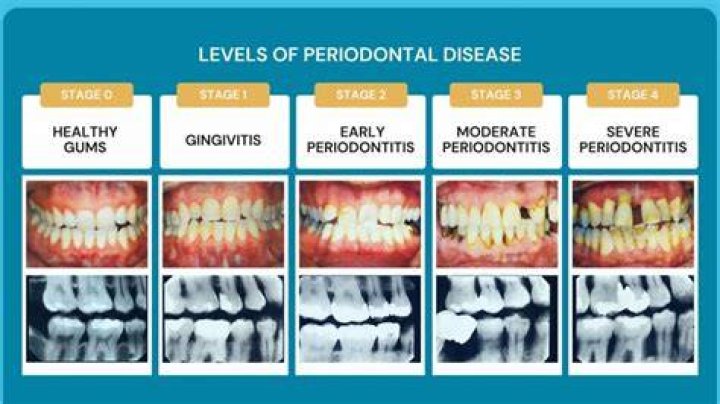 Can you stop slight periodontal disease?