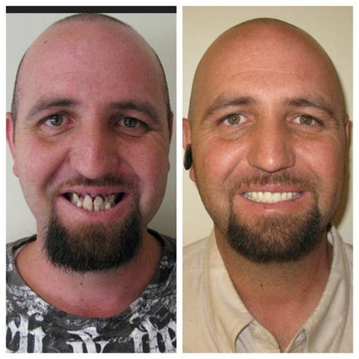 Can you tell if someone has dentures?
