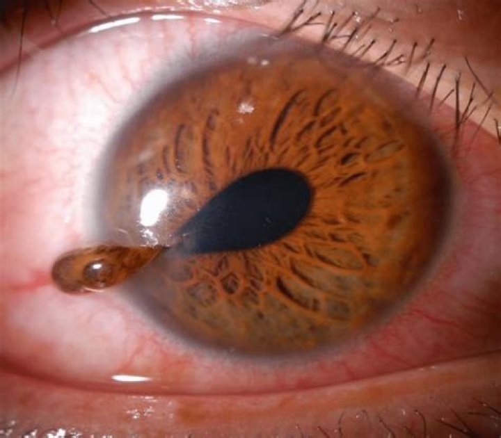 Can your eye explode?