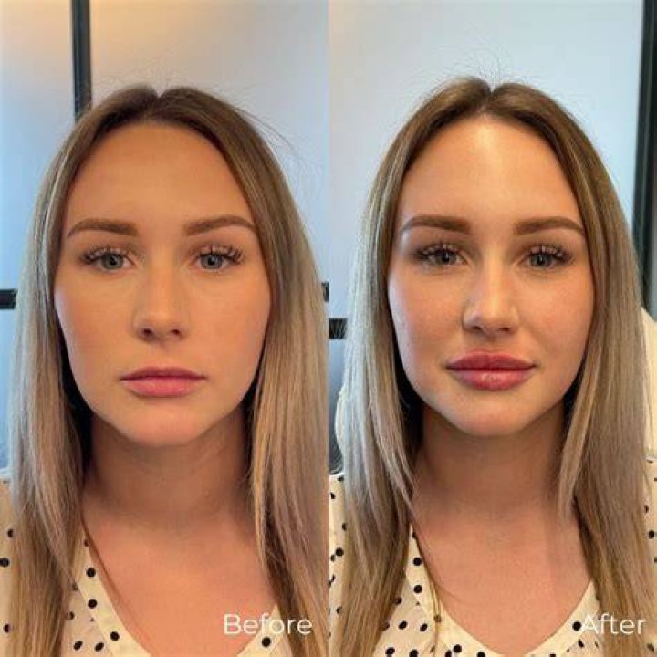 Do and don'ts before lip fillers?