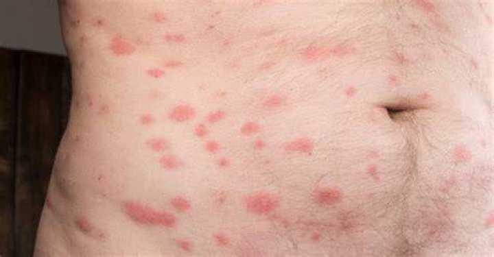 Do bed bug bites look like hives?