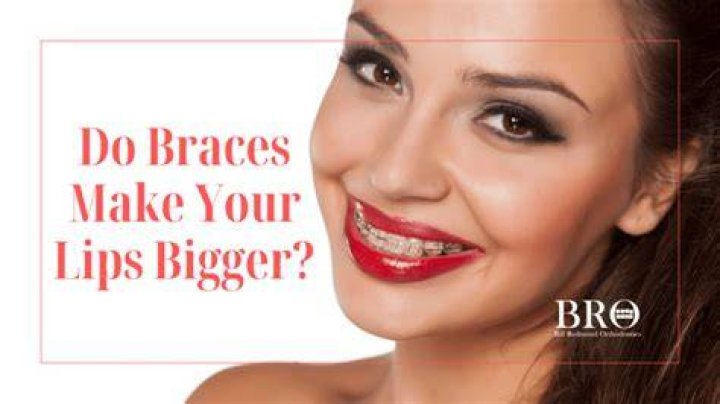 Do braces make teeth look bigger?