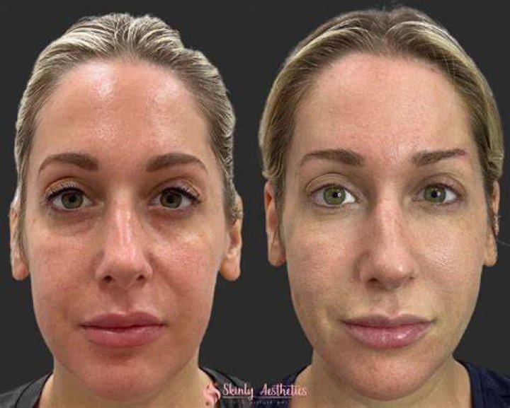 Do celebrities get fillers?