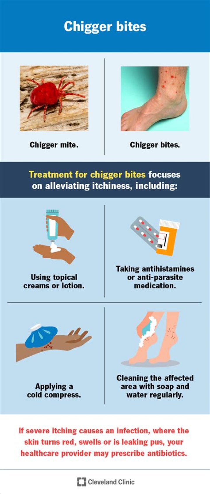 Do chiggers stay in your bed?