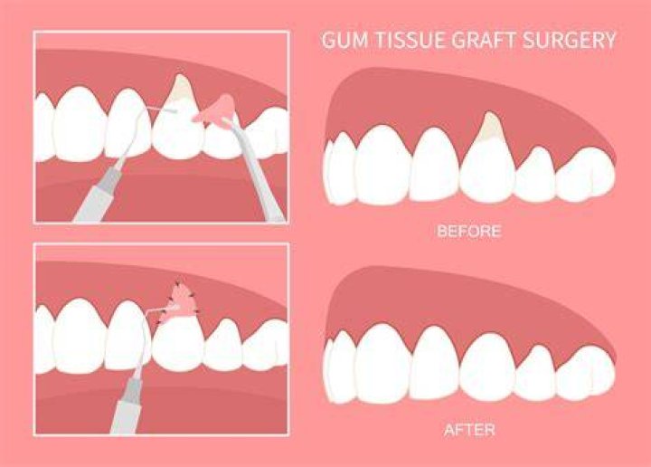 Do gum grafts look normal?