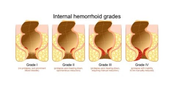 Do internal hemorrhoids cause pressure?