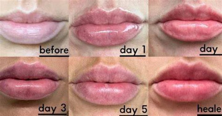 Do lips heal fast?