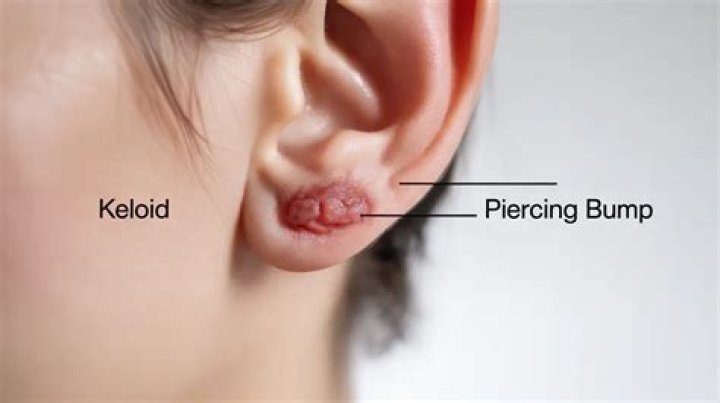 Do piercing keloids go away?