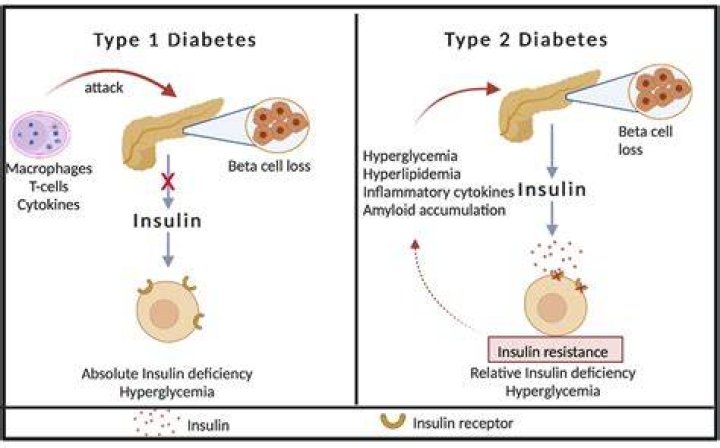 Do type 1 diabetics still need their pancreas?