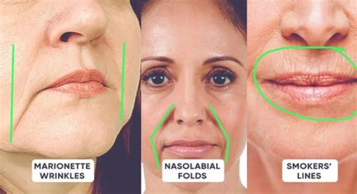 Do vegans get more wrinkles?