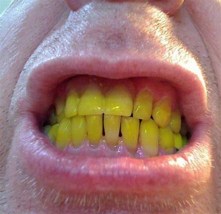 Do yellow teeth go away?