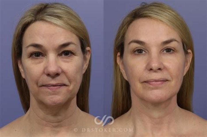 Does a facelift make you look younger?